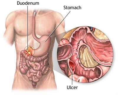 Hemoragii digestive de origine digestiva